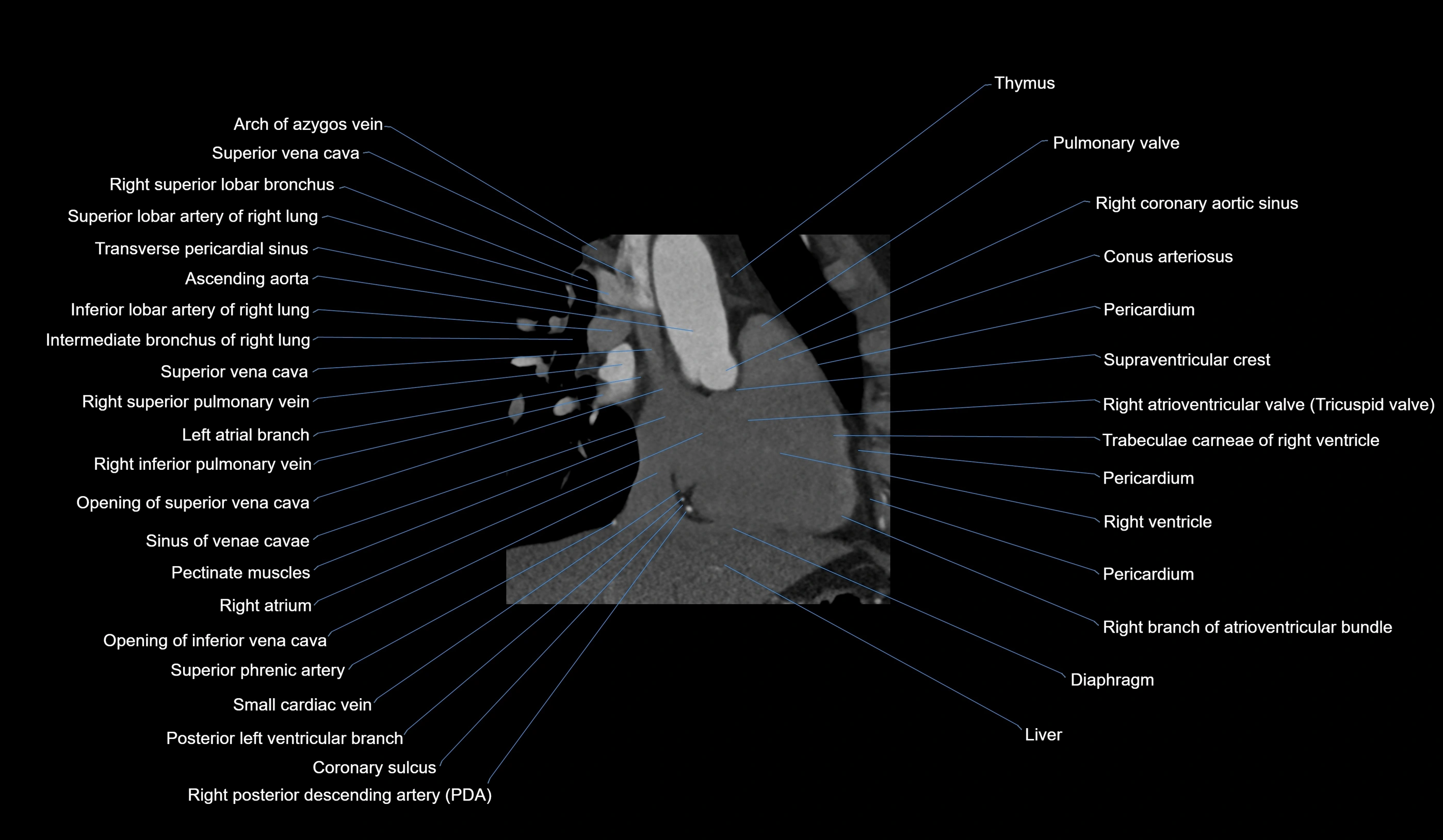 CT heart (coronary angiogram) 2 chamber view cross sectional anatomy labelled radiology image-00027.webp